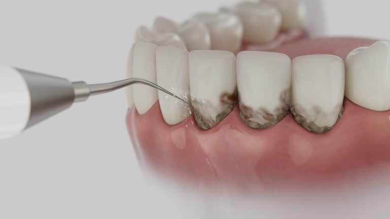 Reliable Wisdom Tooth Removal contractor in Johnson County County, TN by Dentist Open Now